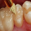 fixed removable hybrid prosthesis