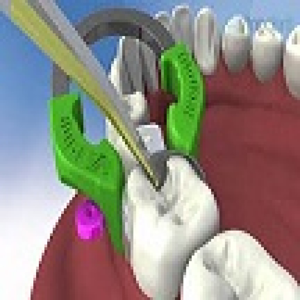 fixed removable hybrid prosthesis