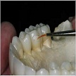 fixed removable hybrid prosthesis