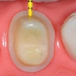 fixed removable hybrid prosthesis